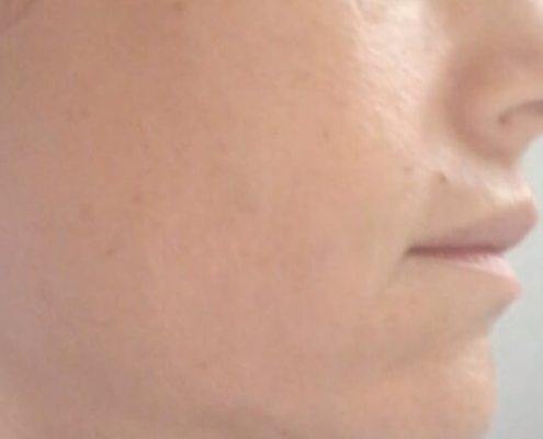 Kako se pomladiti - stanje nakon primjene skinboostera