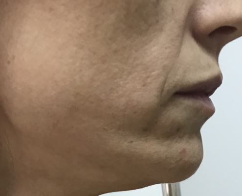 Kako se pomladiti - stanje prije primjene skinboostera