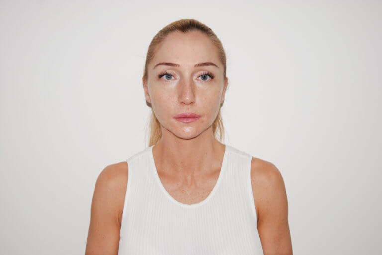 Neposredno nakon tretmana skinboosterom